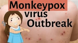 monkeypox
