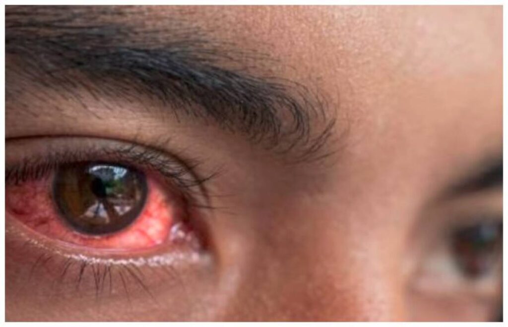 Conjunctivitis 1024x660 1