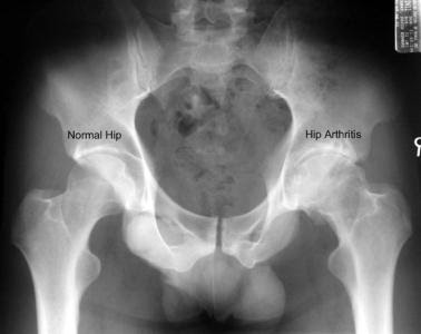 hip arthritis